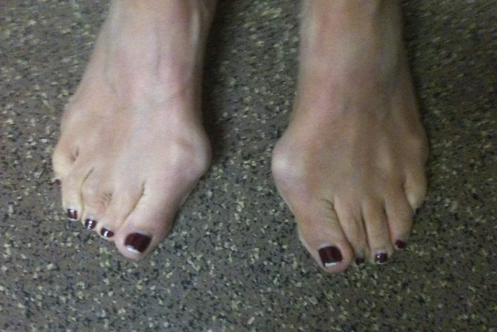 Hallux Valgus Clinical